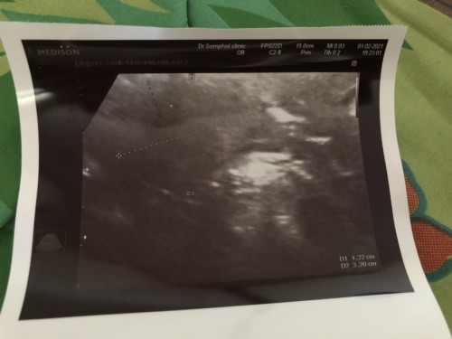 ท้องแต่ซาวด์ไม่เห็นถุงตั้งครรภ์