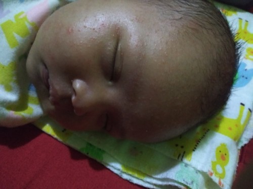 Ruam merah pada wajah
