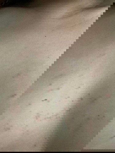 Pimple near chest