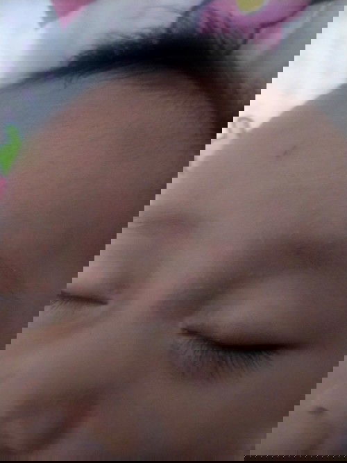 Bintik merah diwajah ai bayi