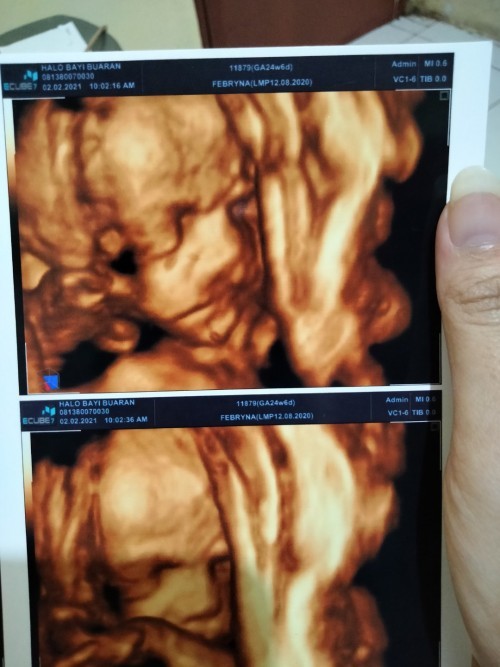 Aku takut banget sama bibir bayiku. Tapi dr blg ini normal,pas udah klr hasil aku kaget. Sumbing bkn