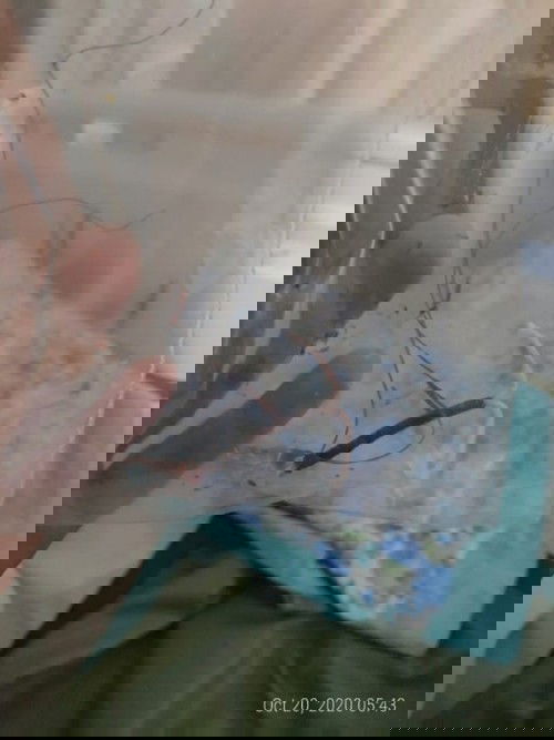 Lepas IUD dengan Bius Total (+AUB)