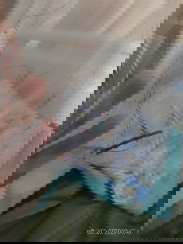 Lepas IUD dengan Bius Total (+AUB)