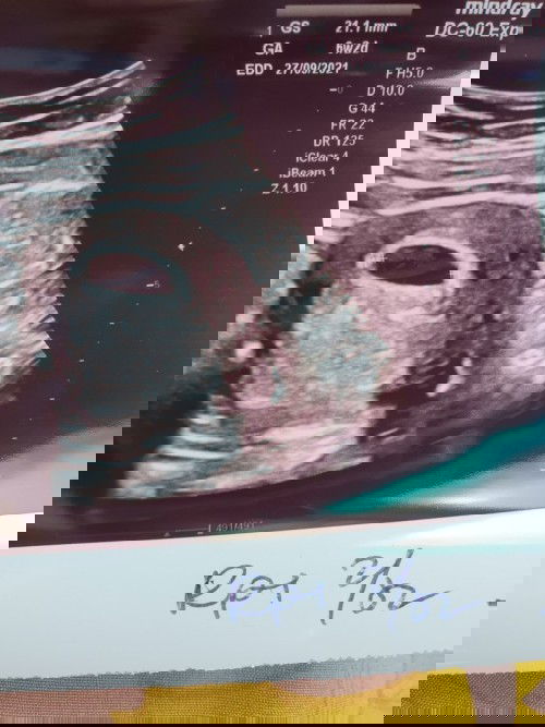 Hamil 6mnggu+ hanya kantung janin belum nampak bilang dr tadi tunggu 2 weeks lagi... Risau aku...