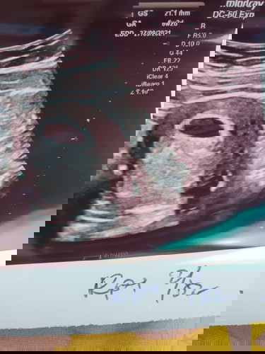 Hamil 6mnggu+ hanya kantung janin belum nampak bilang dr tadi tunggu 2 weeks lagi... Risau aku...