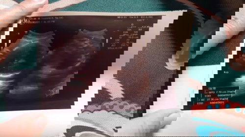 Bund kemarin sy usg di 31 minggu trus bbj 1700 gram trus posisi kpl.y udah dbawh. Ad yg sama gk bun?