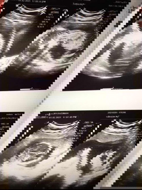 Flek coklat diusia kandungan 16w