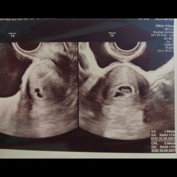 Ukuran janin dan detak jantung