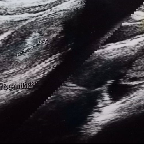 Apakah cairan bebas itu berbahaya pada uk 4week?