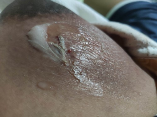 Mastisis. Need help 😭😭