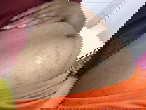 ท้องแตกลาย ท้องแรก 8เดือนแล้วค่ะ