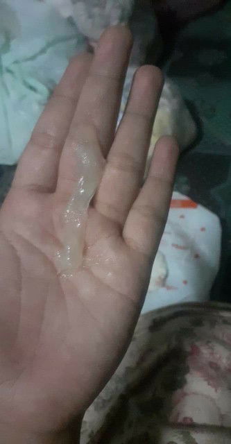 เป็นแบบนี้มาสองครั้งแล้วค่ะมีอาการปั้นท้องเจ็บท้องตอนปั้นค่ะ 
แบบนี้ใกล้คลอดหรือยังค่ะ 37+1วิค