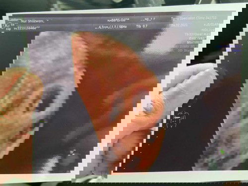 6 weeks dark/light brown spotting on off