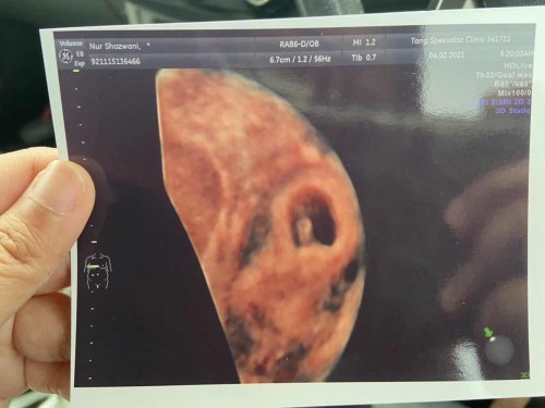 6 weeks dark/light brown spotting on off