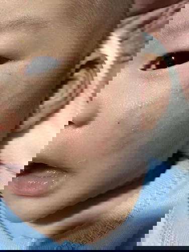 ผื่นขึ้นหน้า แบบนี้ใช้อะไรหายค่ะ