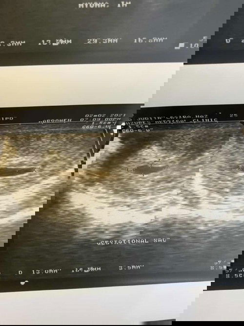 5weeks gestational sac