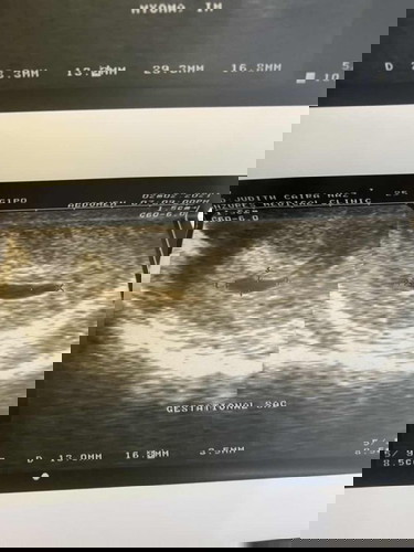 5weeks gestational sac