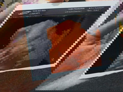 30 week terlilit tali pusar