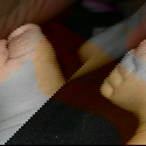 Kulit kaki (bayi 3 bulan ) bruntusan