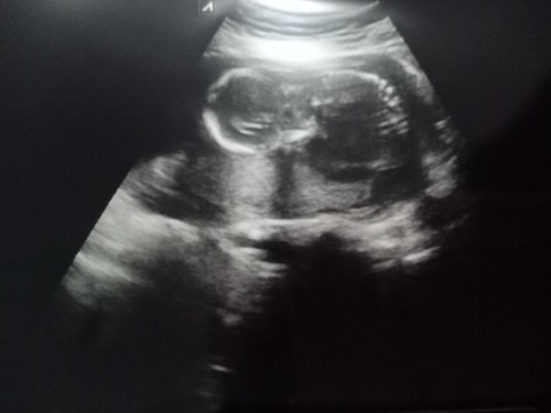 Posisi janin dibawah usia 17 week
