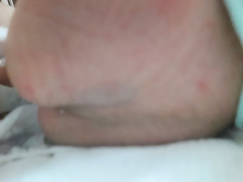 Guhit sa likod ng pwet