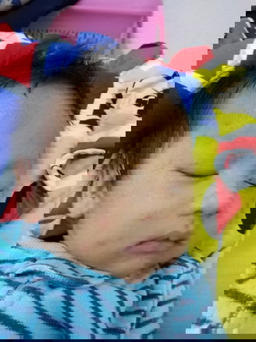 ขอวิธีแก้ผดที่หน้าหน่อยค่ะ