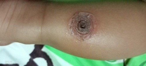 Bun bolle tanya knp ya, kok kaki anak saya, lukanya makin hari makin bsar apa ini Krn alergi Susu