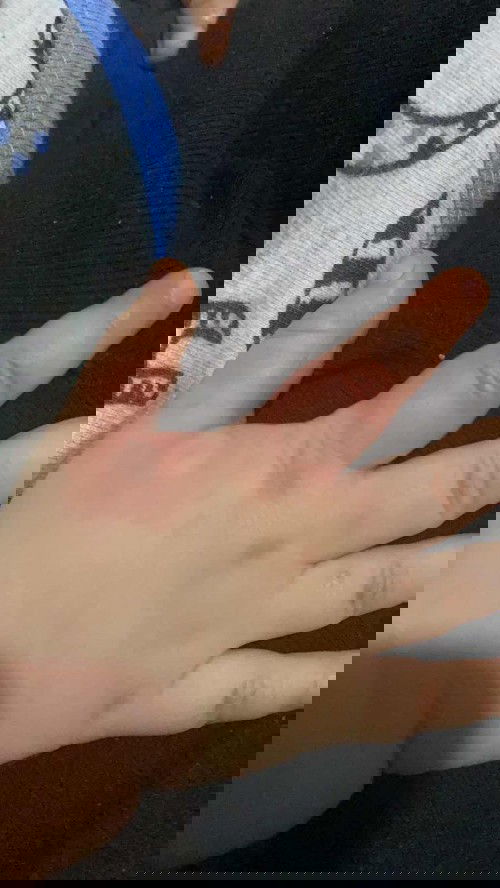 Kagat ng ano?baby 11 months old