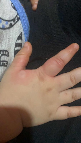 Kagat ng ano?baby 11 months old