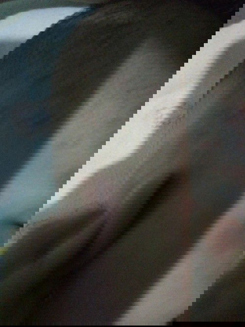 Bercak merah yang hilang timbul