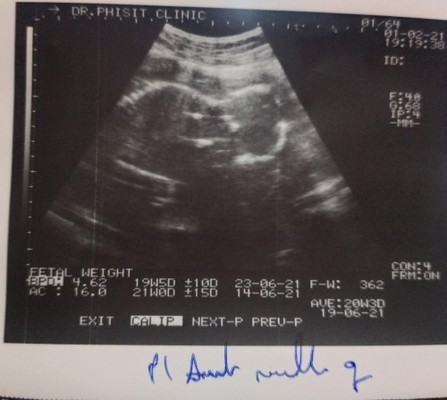 รูปตอน19+6สัปดาห์