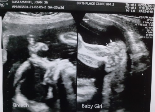 6 mos.preggy breech position