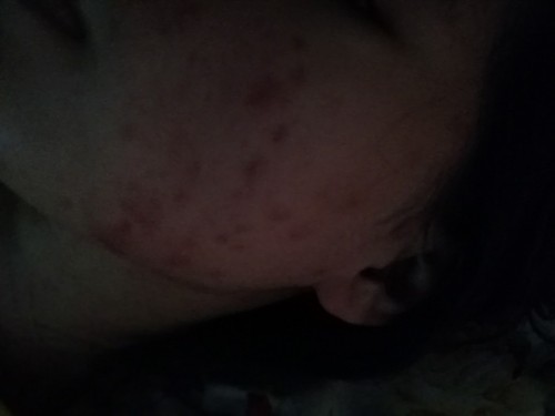 Pregnancy breakouts