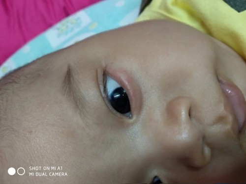 Merah pada kelopak mata bayi 3 bulan