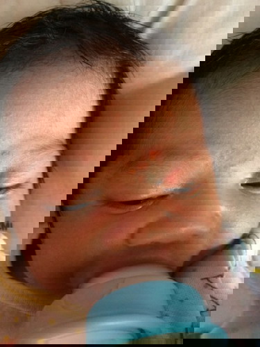 สอบถามแม่ๆหน่อยคะมีลูกๆบ้านไหนเป็นแบบนี้บ้างแม่ๆแนะนำครีมดีๆหน่อยคะ