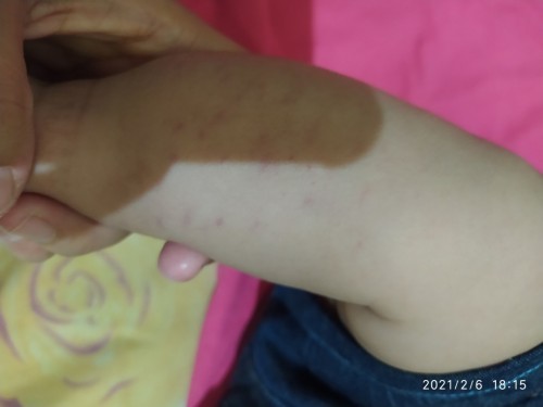 Bintik bintik merah kebiru2an