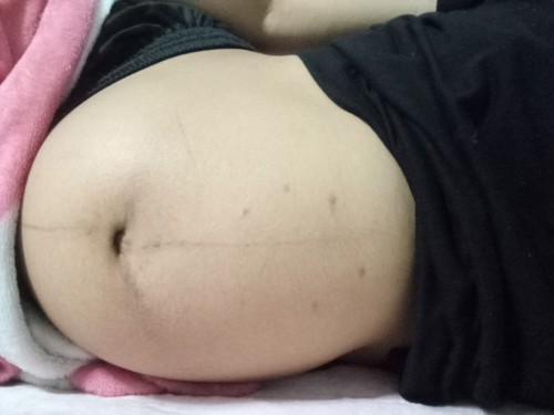 สิวขึ้นที่ท้อง