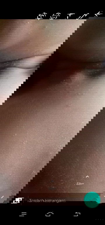 Cara mengatasi ruam pada leher bayi