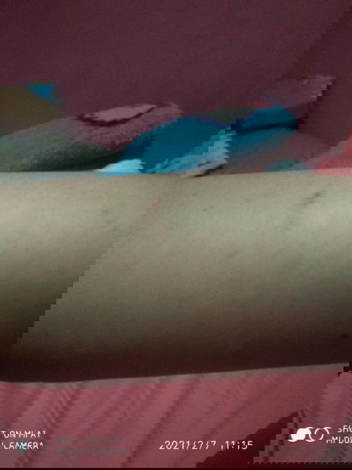 gatal2 pada kulit usia kandungan 15 weeks