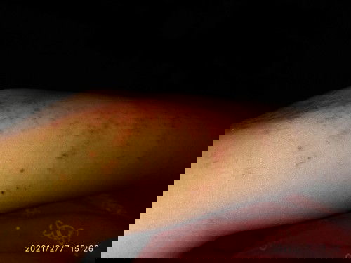 Gatal gatal di tangan dan kaki