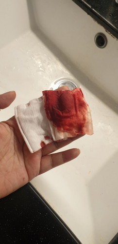 Red bleeding when wiping.