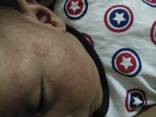 ตุ่มใสๆคล้ายหนอง