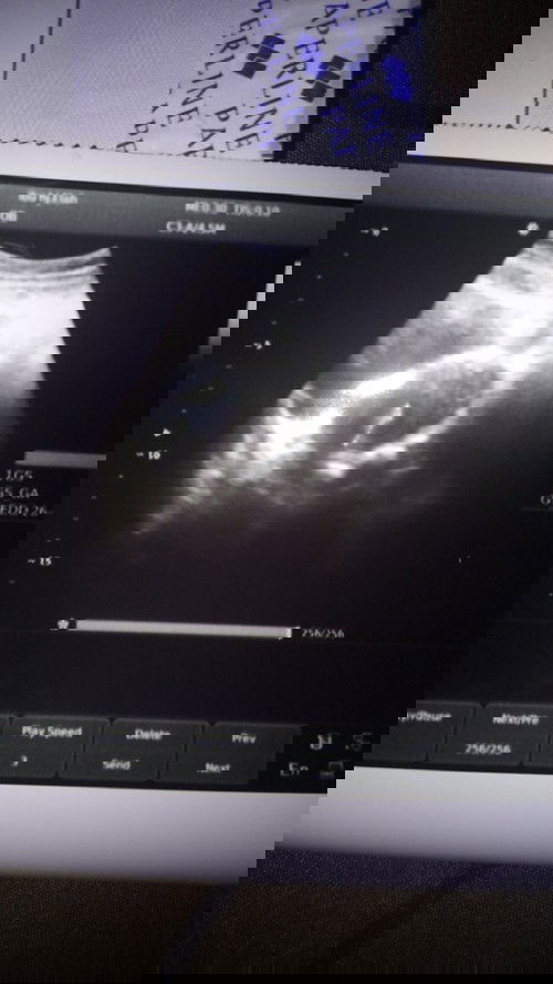 Aku bru 8 week tpi skrng pendarahan tpi kta dokter msh ada janin ny h