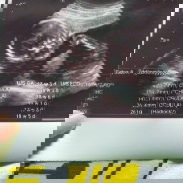 แบบนี้ ญ 100% ไหมค่ะ พอดีจะซื้อของเตรียมคลอดค่ะ 18 week 3 วัน