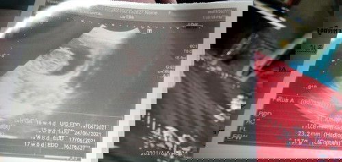 ตอนไปซาวน์เห็นทั้งแขนทั้งขาแต่ตอนได้รูปนี้มาแม่ดูไม่ออกมีแม่ๆท่านไหนช่วยอธิบายได้บ้างค่ะ#ท้องแรกค่ะ