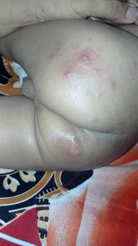 Apa yah obat gatalnya