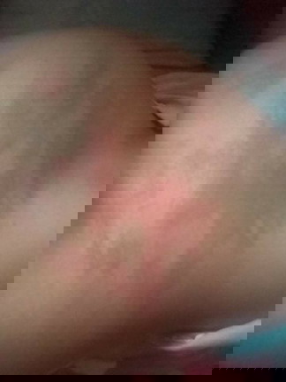 Rashes o stretch mark