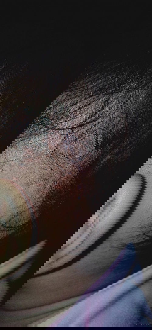 bruntusan, alergi atau biang keringat