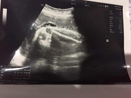 ใบอัลตราซาวน์