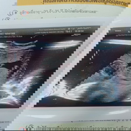 ใครพอจะรู้ค่าของการวัดต้นคอคัดกรองดาวซินโดรมบ้าง